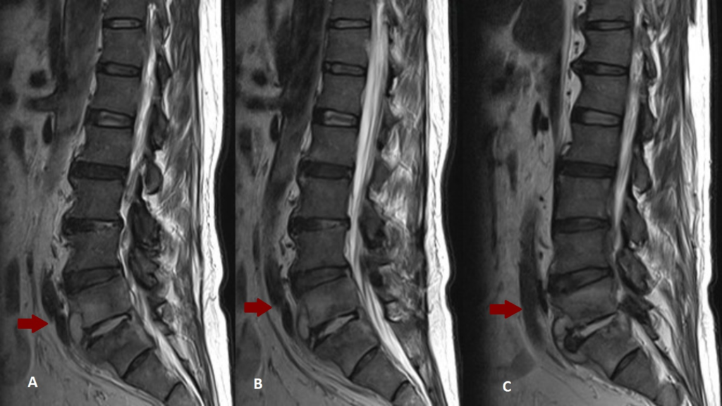 Symptoms, Diagnosis, and Treatment of Pott's Disease - magazinelo